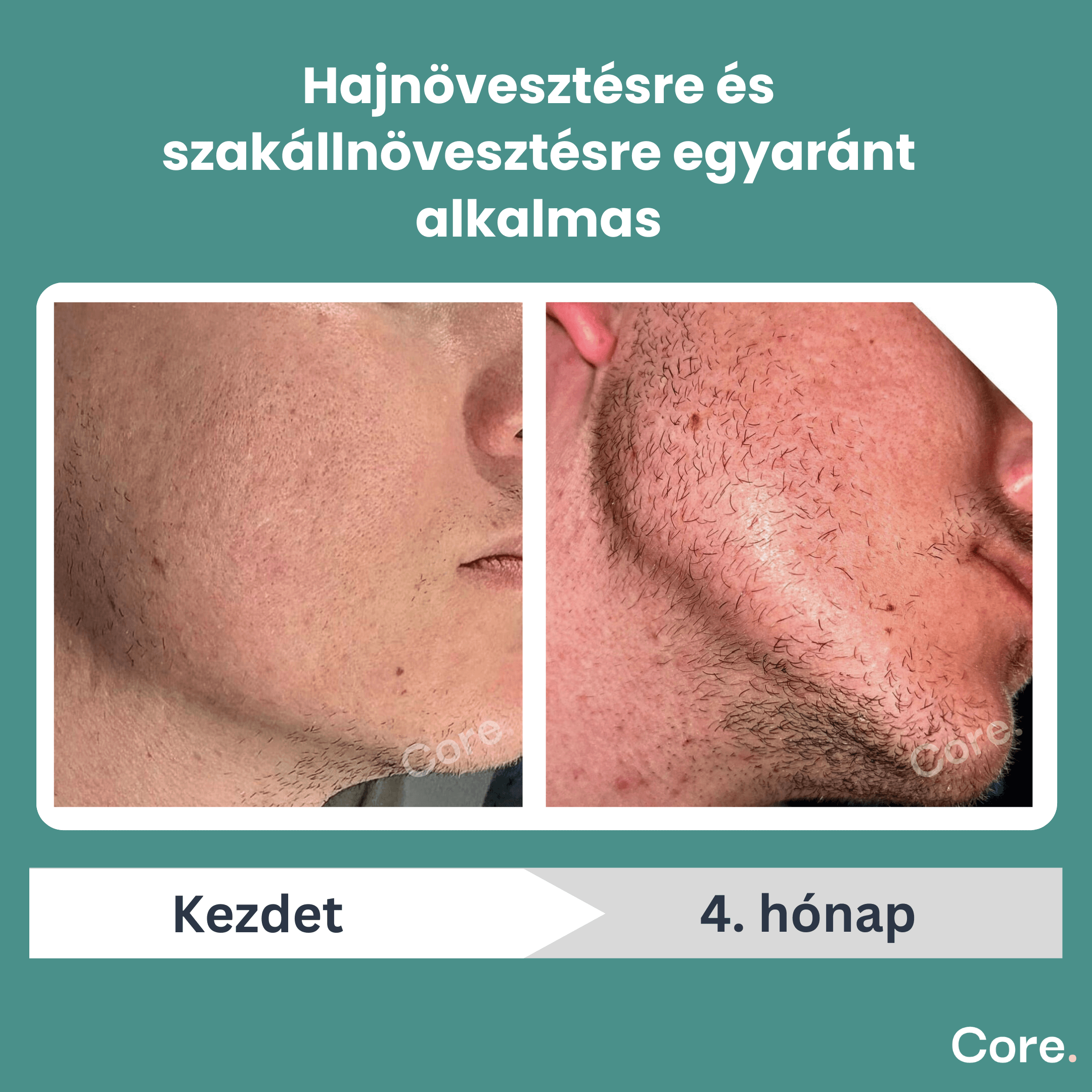 Kirkland Minoxidil 5% haj-, és szakállnövesztő - 2 havi adag folyadék
